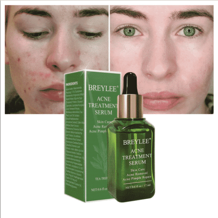 Breylee Acne Treatment Serum