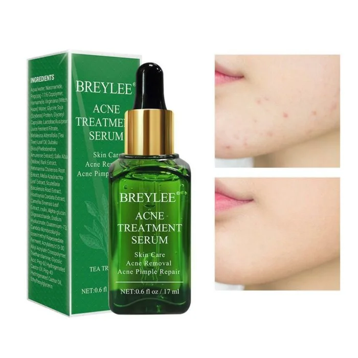 Breylee Acne Treatment Serum