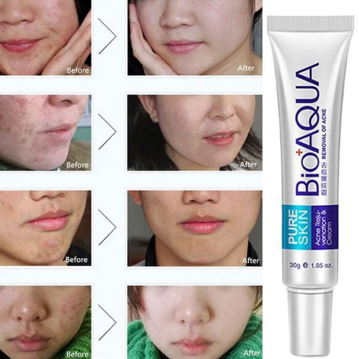 Bioaqua Acne Cream Scars Removal Face Cream