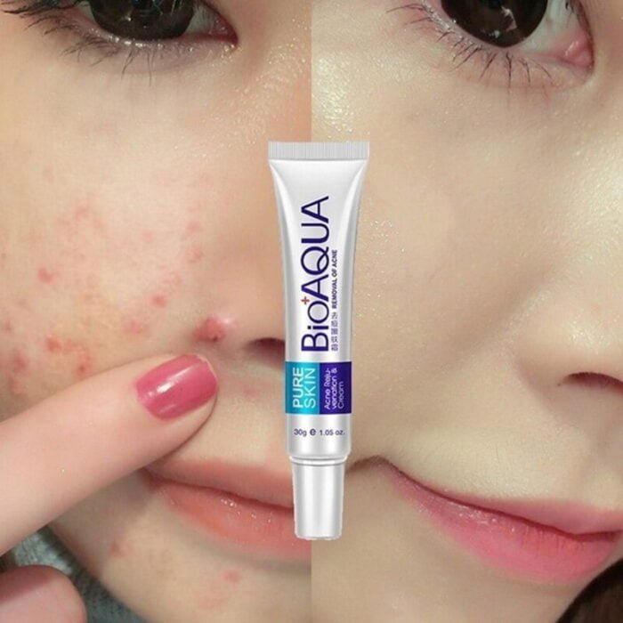 Bioaqua Acne Cream Scars Removal Face Cream