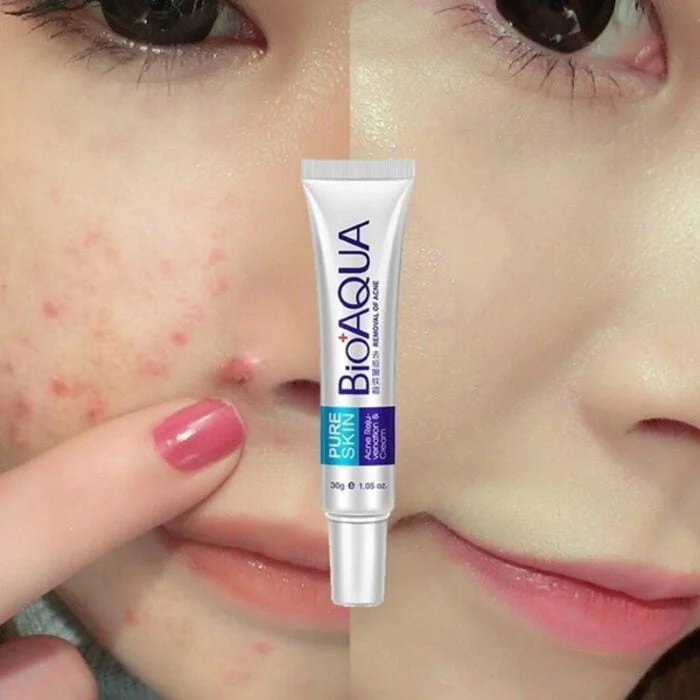 Bioaqua Acne Cream Scars Removal Face Cream