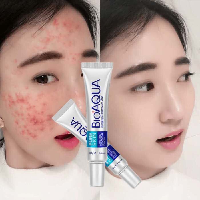 Bioaqua Acne Cream Scars Removal Face Cream