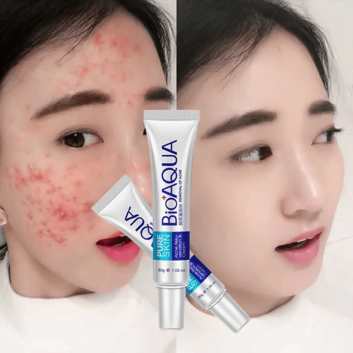 Bioaqua Acne Cream Scars Removal Face Cream