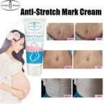 Aichun Beauty Anti Stretch Mark Cream