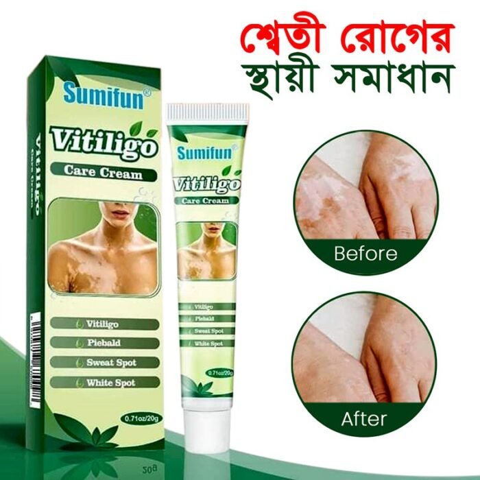Sumifun Vitiligo Cream