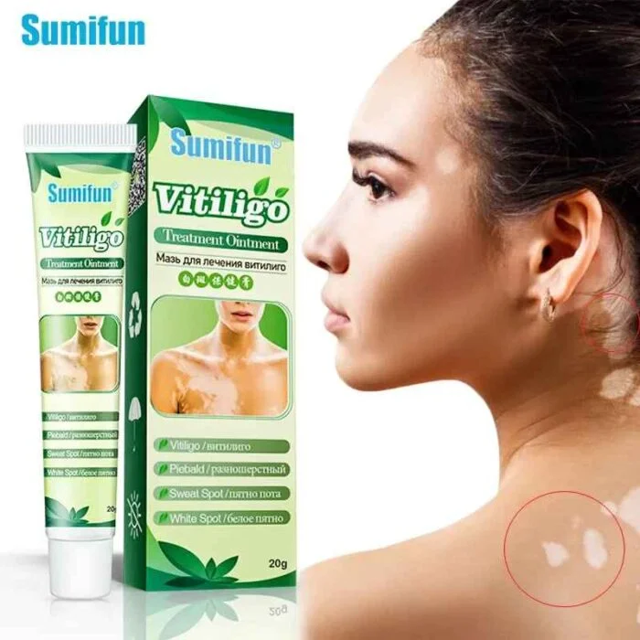 Sumifun Vitiligo Cream